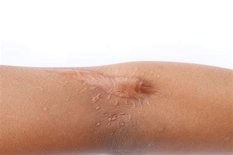 premium photo close   hand  scars  white background