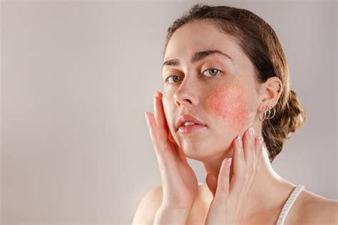 Redness, Facial Redness | Mill Creek Skin and Laser