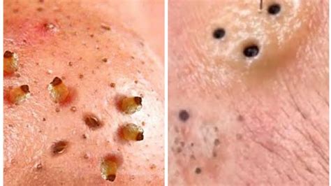Forget Everything You Know: Unbelievable Blackhead Removal 2024 Revealed - ckut1vl