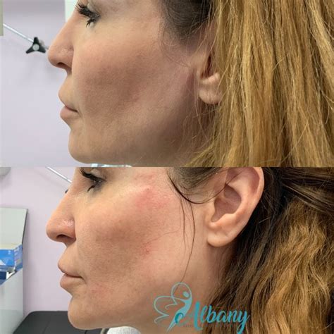 Cheek Fillers: Case Study No. 1347 Albany Cosmetic and Laser Centre In ...