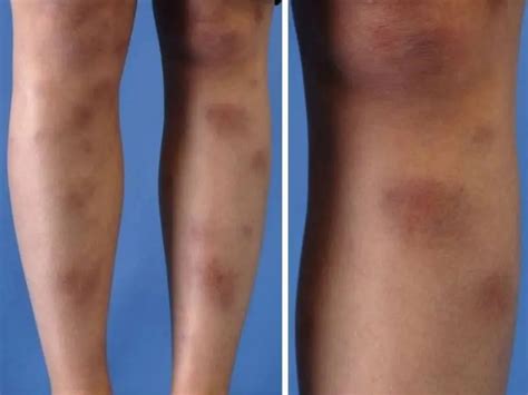 Erythema nodosum: photos, symptoms and treatment | Diseases and conditions
