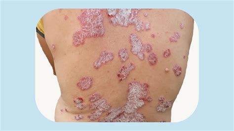 types  psoriasis