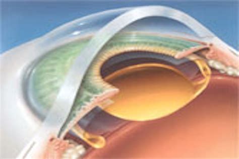 Phaco Nightmares Conquering Cataract Catastrophes By Amar Agarwal Ms Frcs Frcophth 2006 06 01 2