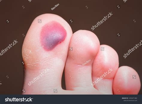 blood blister footsore  skin foot stock photo  shutterstock
