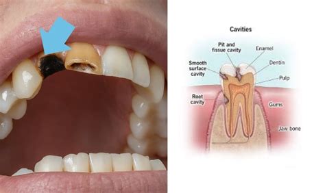 How To Avoid Cavity Pain: A Comprehensive Guide