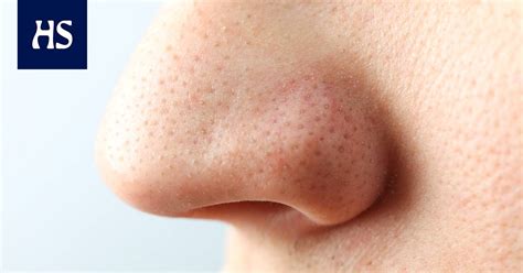 Skin care | Sebum fibers are important for skin health, but many people ...