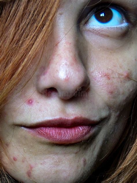 Woman`s Face with Severe Acne / Skin Condition Stock Image - Image of ...
