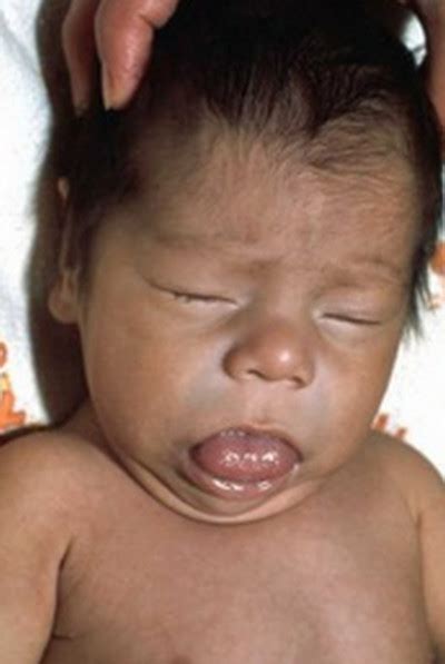 Cretinism | Current Health Advice, Health Blog Articles and Tips
