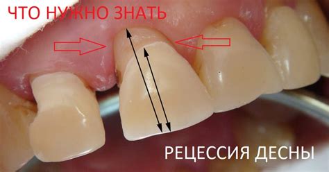 Лечение и закрытие рецессии десны в ТОП1 клинике Москвы - Немецком ...