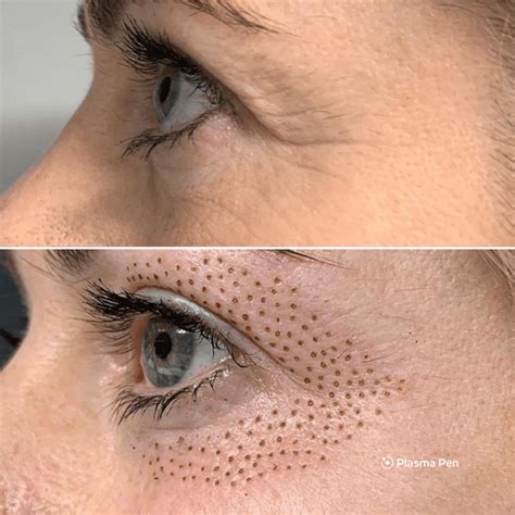 Plasma Pen Fibroblast - Balancemedspa.com