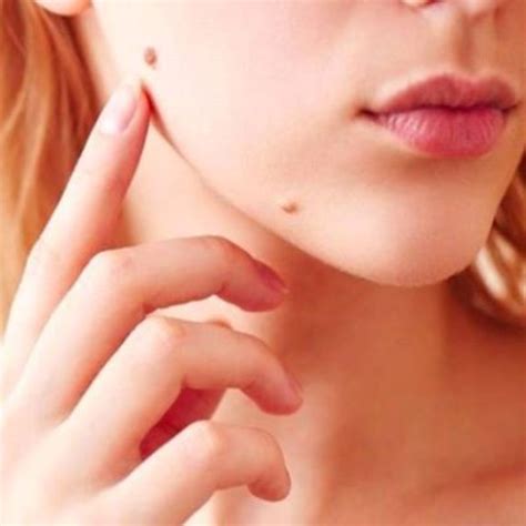 laser wart removal  rajkot safe  effective treatment