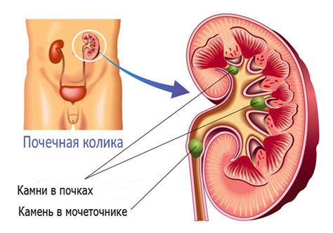 Лекарство от камней в почках: как выбрать лучшее