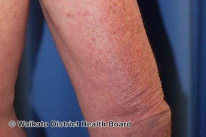 rashes symptoms  treatment westerville dermatology