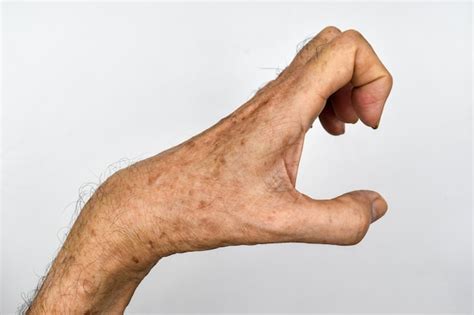 Premium Photo | Volkmann's contracture in southeast asian elder man