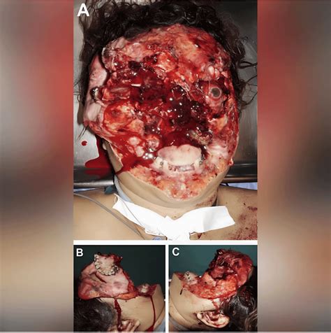 severe facial trauma  repair rmedicalgore