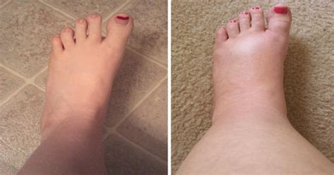 how to get rid of a swollen foot