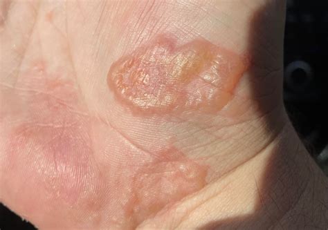 Rash/Blister on my hand. Any thoughts? : r/Dermatology