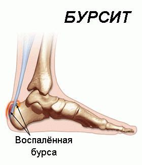 Бурсит пятки: причины, симптомы и лечение