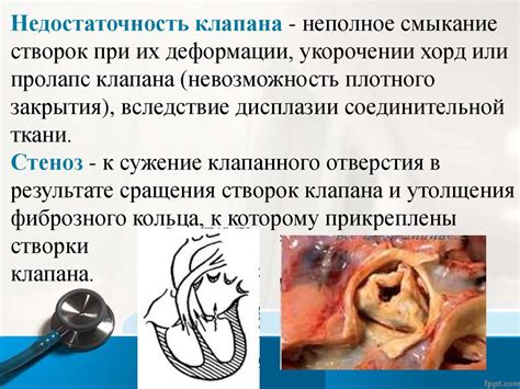 Приобретенные пороки сердца - презентация онлайн