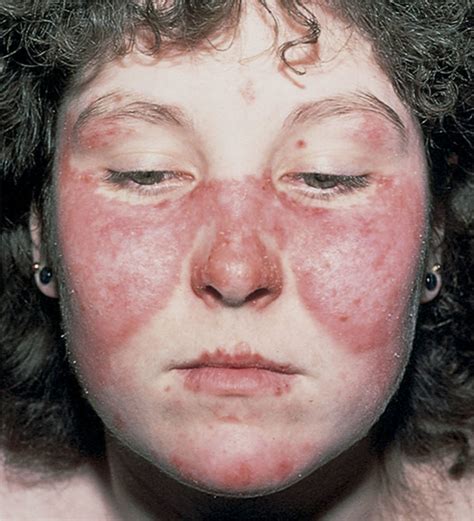 Polymorphic Light Eruption - Causes, Rash, Treatment