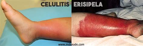 Celulite X Erisipela - Erisipela y celulitis - Síntomas y Tratamiento - MD.Saúde