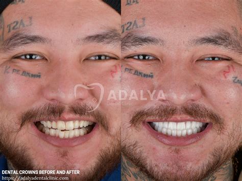 Dental Crowns Before and After | Adalya Dental Clinic