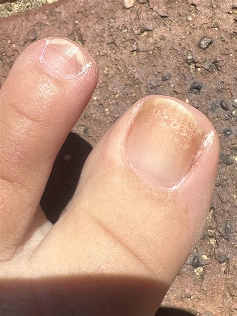 Toenail psoriasis : r/Psoriasis