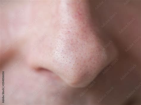 Pimple blackheads on the nose. Close up. Stock Photo | Adobe Stock