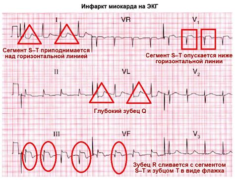 ЭКГ: что это, расшифровка, показатели нормы (таблица)
