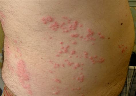 Liver Disease Skin Itching