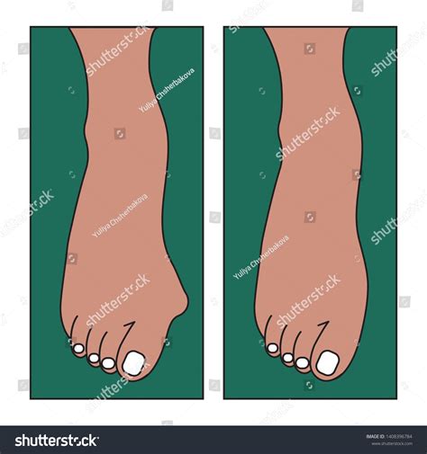 Hallux Valgus Bone Growth On Foot Stock Vector (Royalty Free