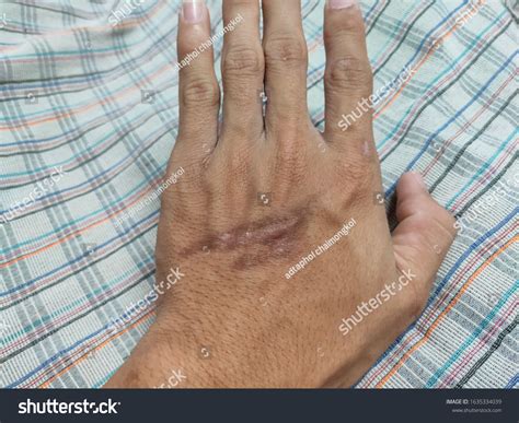 scars   hand stock photo  shutterstock