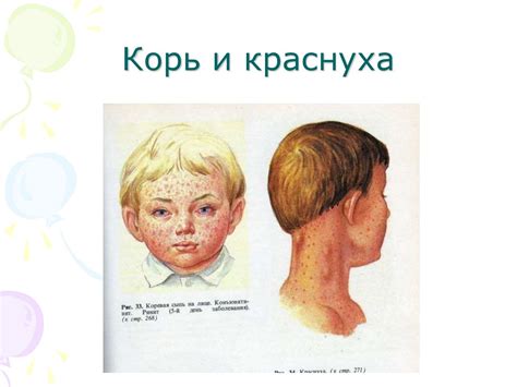 Корь, краснуха, ветряная оспа - презентация онлайн