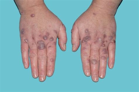 Erythema Elevatum Diutinum