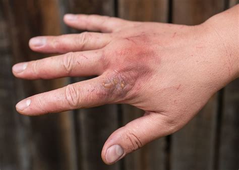 Burns And Heat Injury Treatment First Aid For 2023