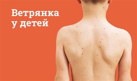 Ветрянка у детей симптомы и лечение: Инкубационный период, как начинается