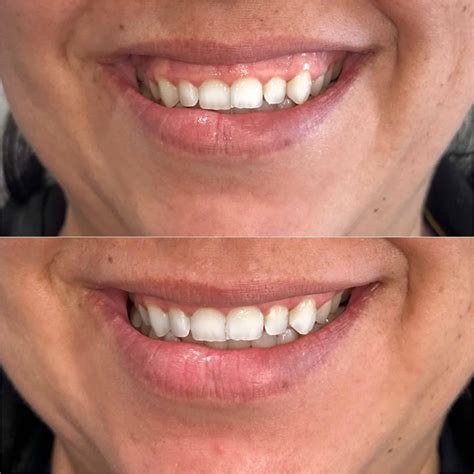 smile line botox 12