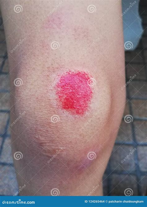Bleeding Scraped Human Knee Royalty-Free Stock Photography