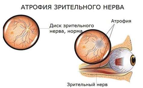 Атрофия зрительного нерва: лечение и диагностика | MedTour