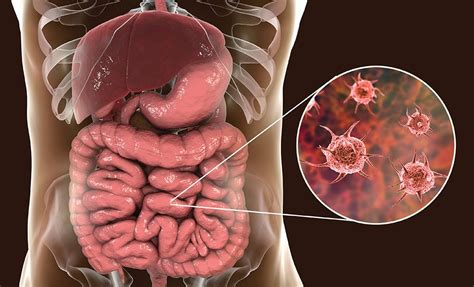 Dysentery - Causes, Symptoms, Diagnosis & Treatment | CK Birla Hospital