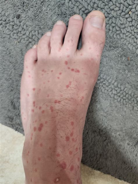 Yellow spot on my upper arm. I thought it was a bruise at first, but it