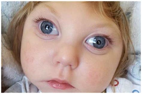 Anensefali Nedir ? » Bilgiustam