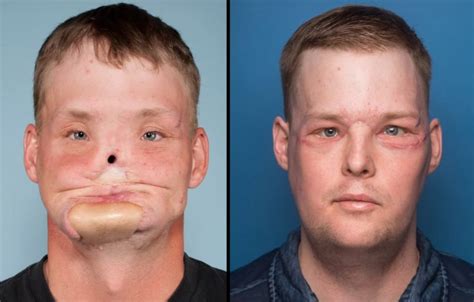 Mayo clinic face transplant surgery gives man a new start in life ...