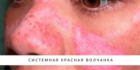 Волчанка красная : симптомы, признаки, диагностика и лечение