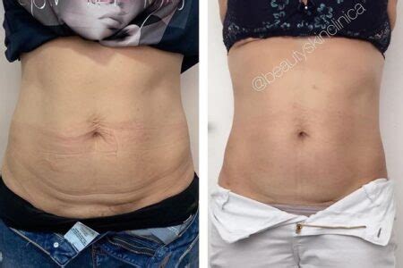 Quanto Tempo A Pele Cola Depois Da Lipo - Lipo enzimática: Antes e depois