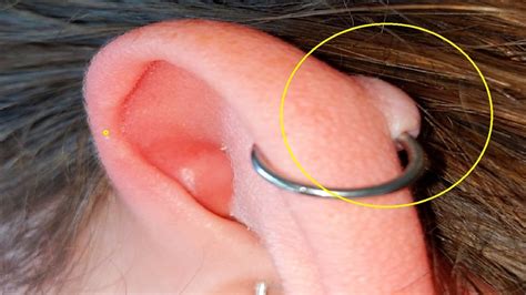 Bump On Ear After Wearing Earrings at Joel Norris blog