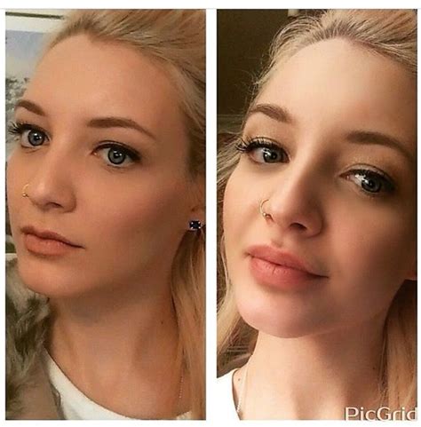 lip fillers near me uk - Trang Julian