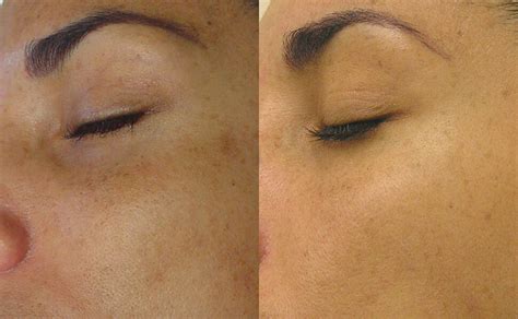HydraFacial Treatment | Lucia Clinic