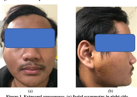 Figure 1 from Parotid Abscess In Young Adult: Case Report | Semantic ...