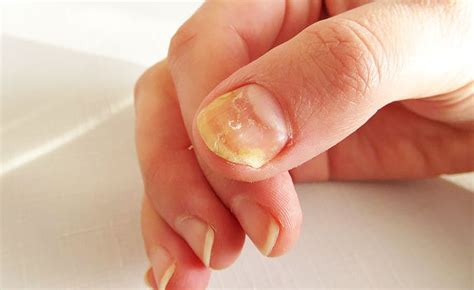 Porque A Unha Fica Amarela - Unha Amarelada: Causas, Tratamento E Prevenção – NETMXE